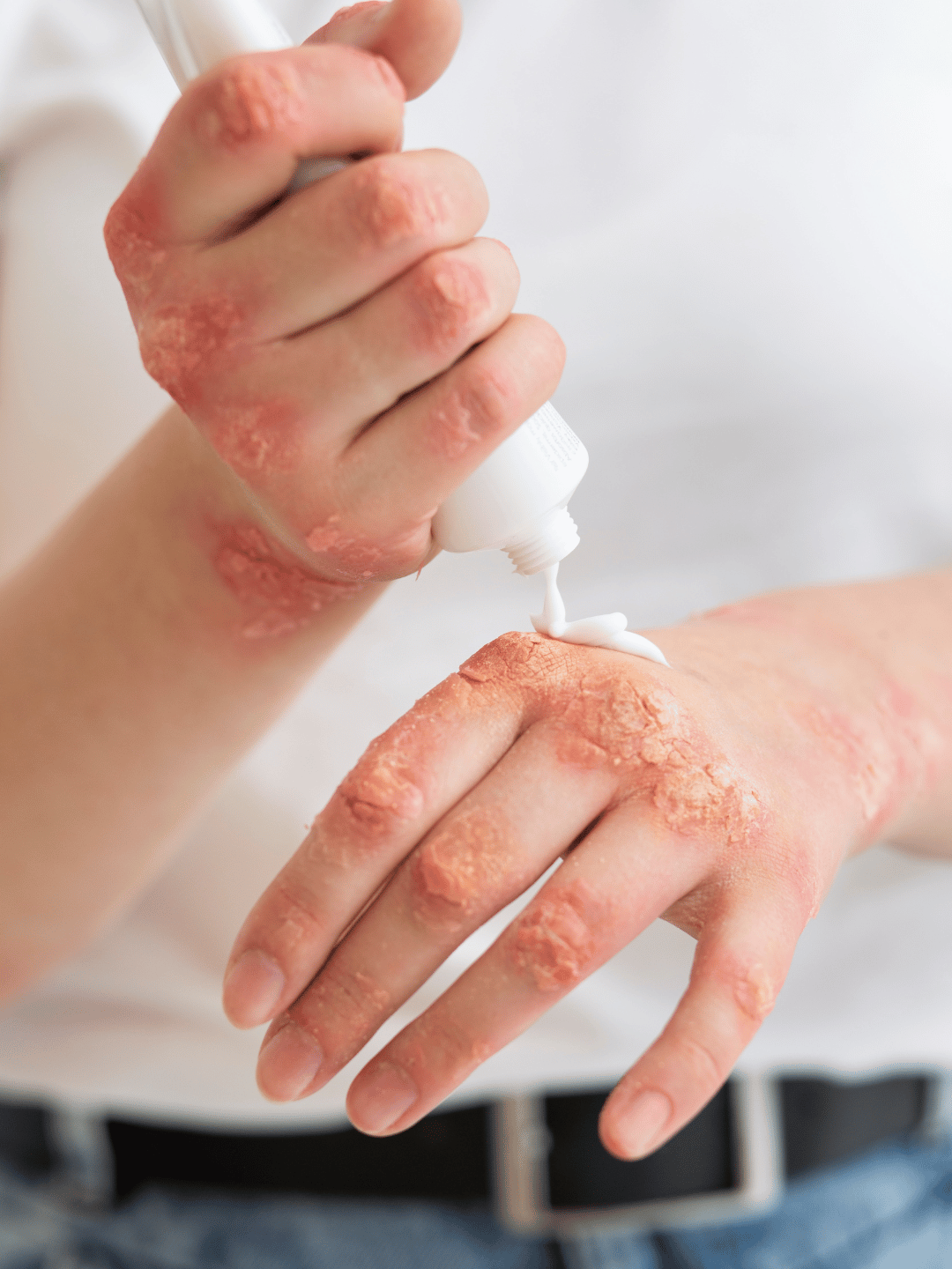 鎖住水分!異位性皮膚炎如何挑選保濕成分