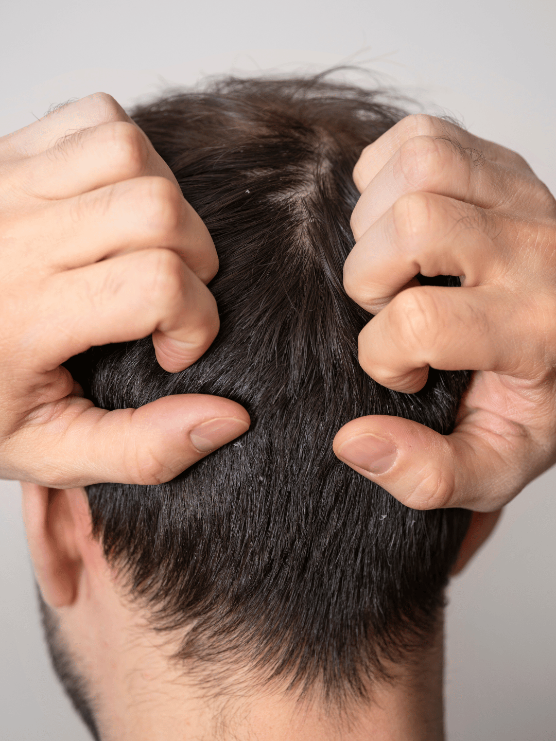 禿頭怎麼救？男性禿頭4大原因與改善攻略